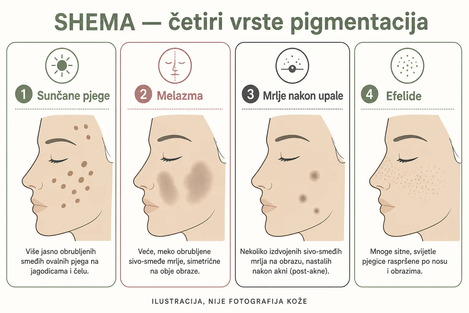 Shematski prikaz četiri vrste pigmentacija — sunčane pjege, melazma, mrlje nakon upale, efelide
